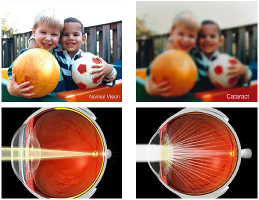 Normal vision compared to vision with cataracts